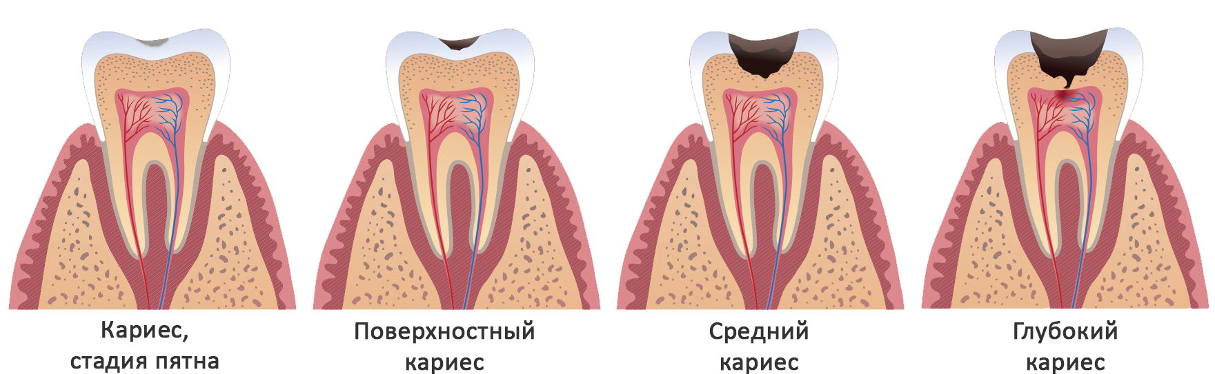 Кариес и все что с ним связано